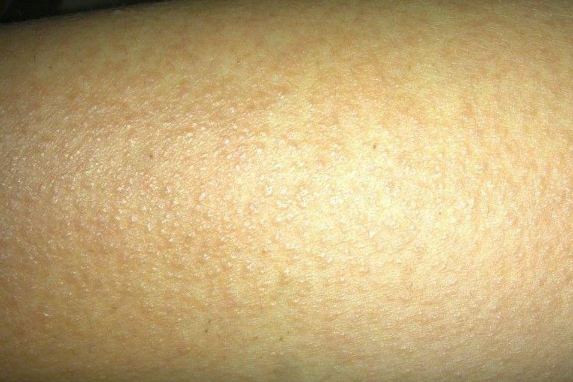 速发型过敏反应