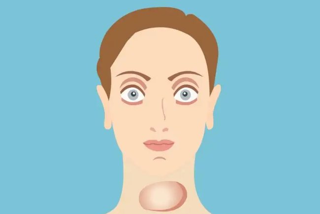 甲状腺功能亢进