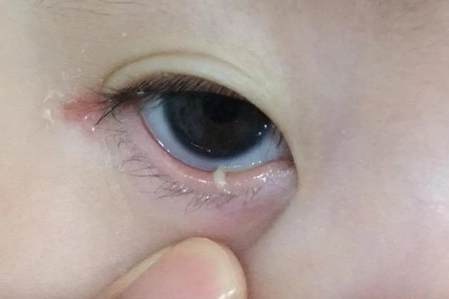 婴儿泪腺堵塞