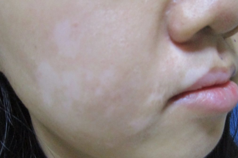 日晒引起的白斑