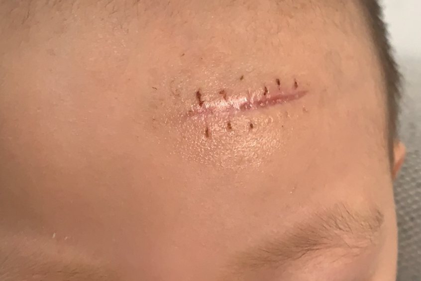 额头缝针后疤痕一个月图片