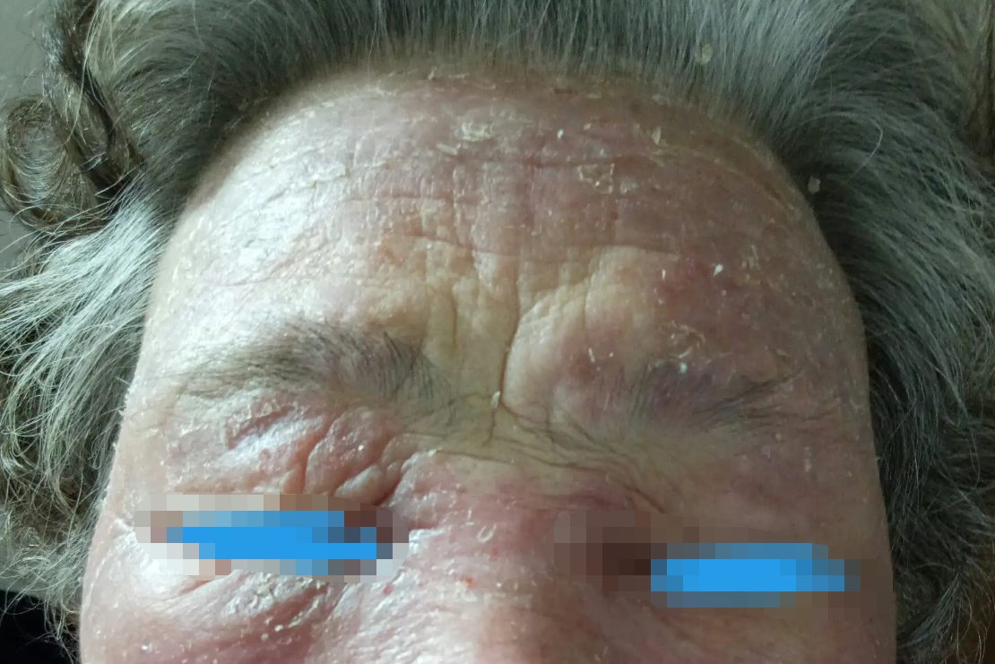 头部过敏性皮炎