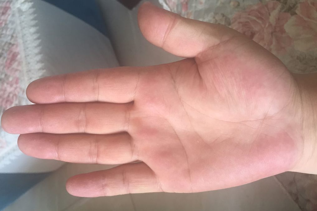 手掌正常颜色的图片