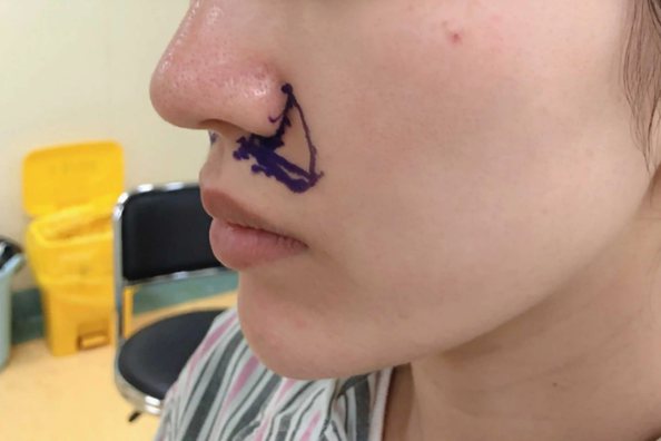 鼻基底假体放置位置