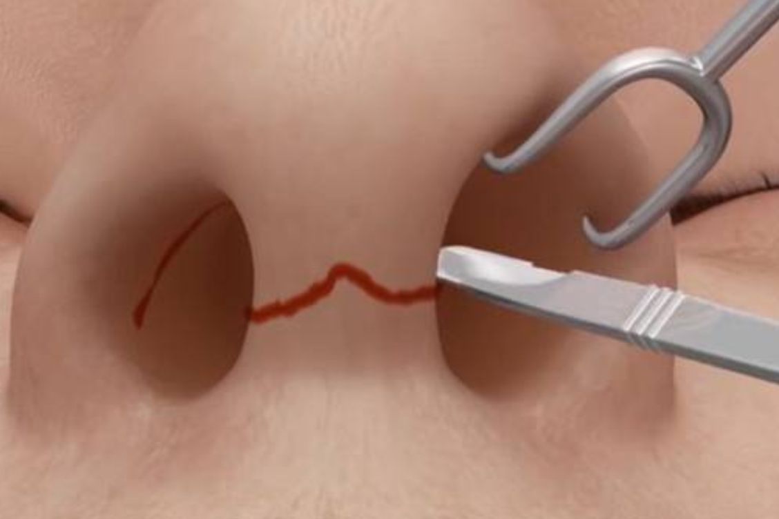 鼻翼内切的切口