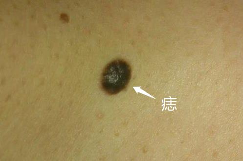 皮内痣