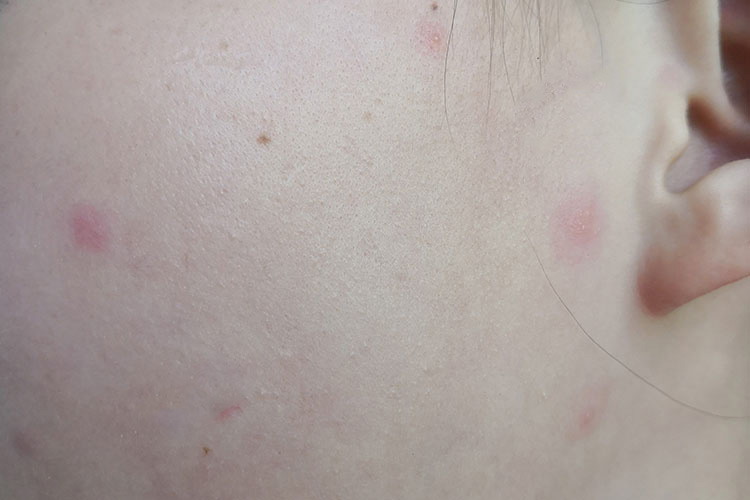 水痘丘疹图