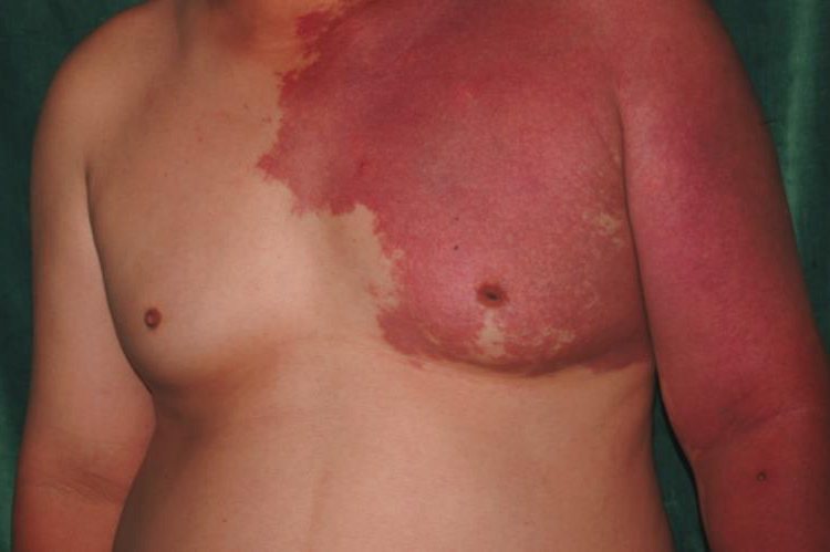 成年人鲜红斑痣