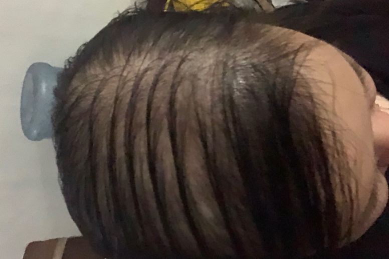 女性脂溢性脱发晚期图片