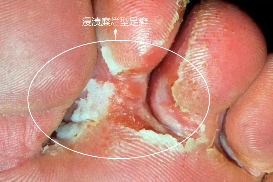 浸渍糜烂型足癣