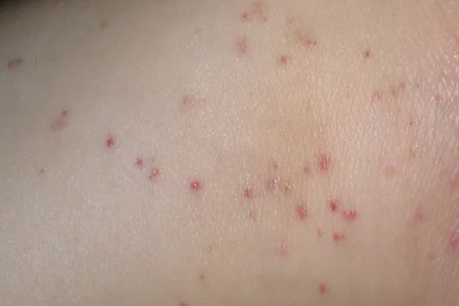 一期梅毒腹股沟图片