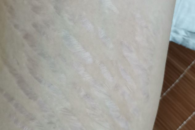 小腿后侧长纹图