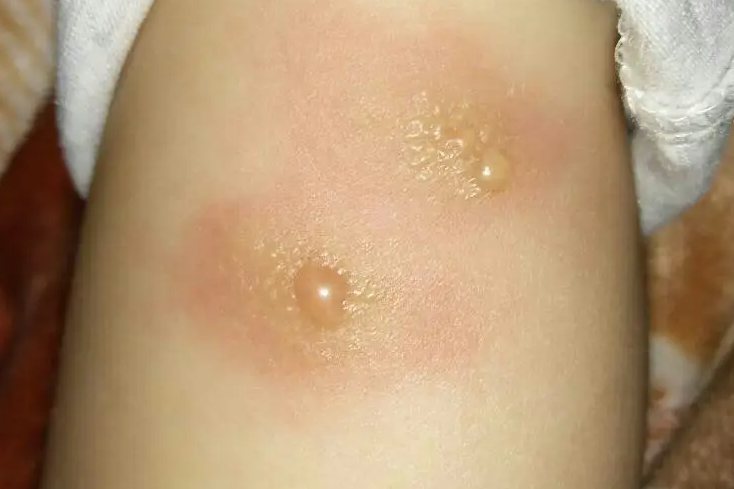 毒虫叮咬