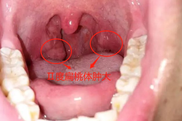 Ⅱ度扁桃体肿大