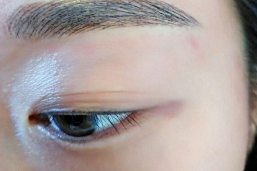 美瞳线掉痂后图片