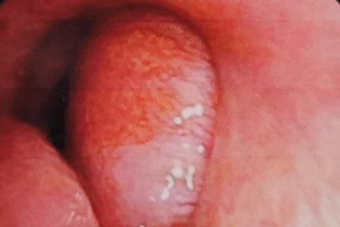 鼻咽纤维血管瘤