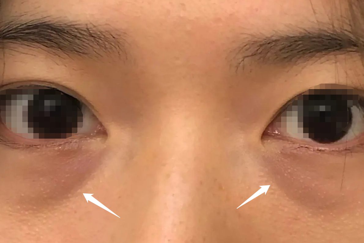 眼袋图