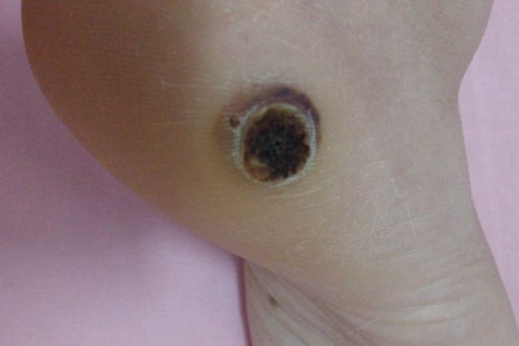 光动力去疣体后的照片