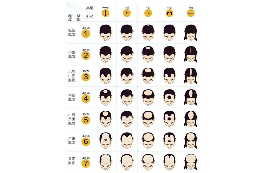 脱发标准对照表