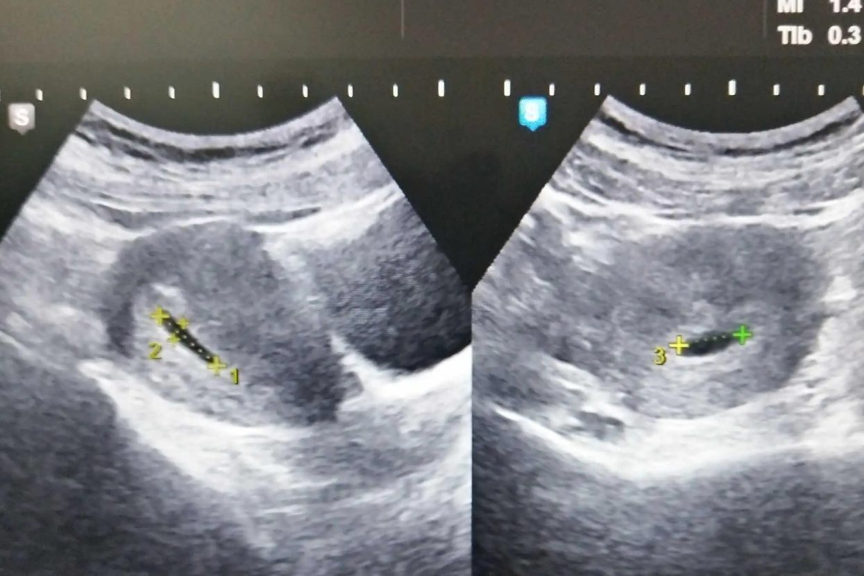 怀孕六周的彩超图片
