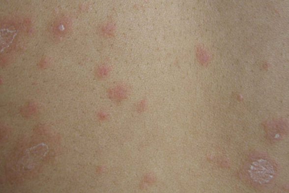 玫瑰糠疹
