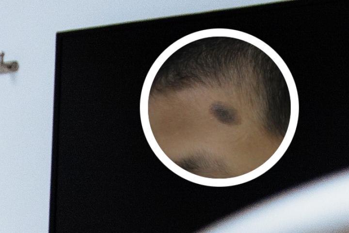 恒瑞免疫治疗血管瘤_恒瑞pd1血管瘤_恒瑞 pd 1 血管瘤