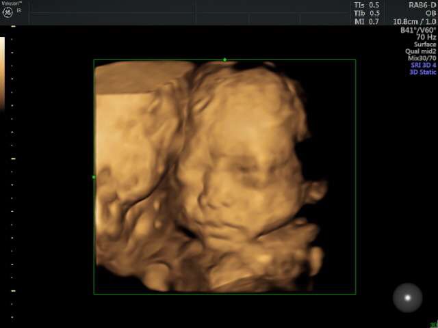 淮北做四维是大排畸吗_四维检查是大排畸吗_四维是大排畸么