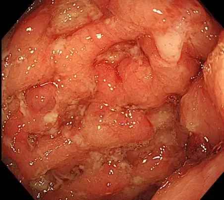克罗恩病最新治疗成果_克罗恩病最新治疗成果_克罗恩病最新治疗成果