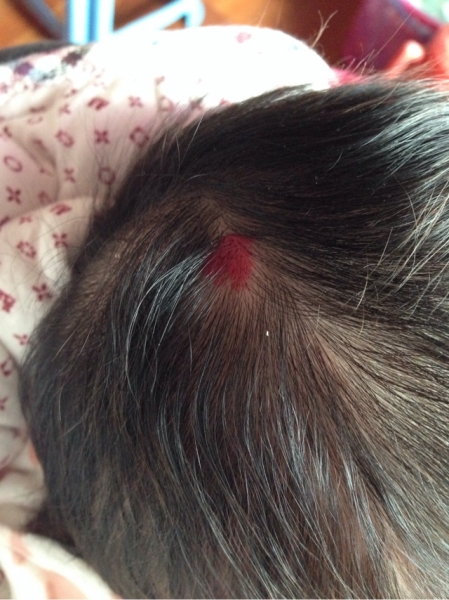 恒瑞pd1血管瘤_恒瑞免疫治疗血管瘤_恒瑞 pd 1 血管瘤