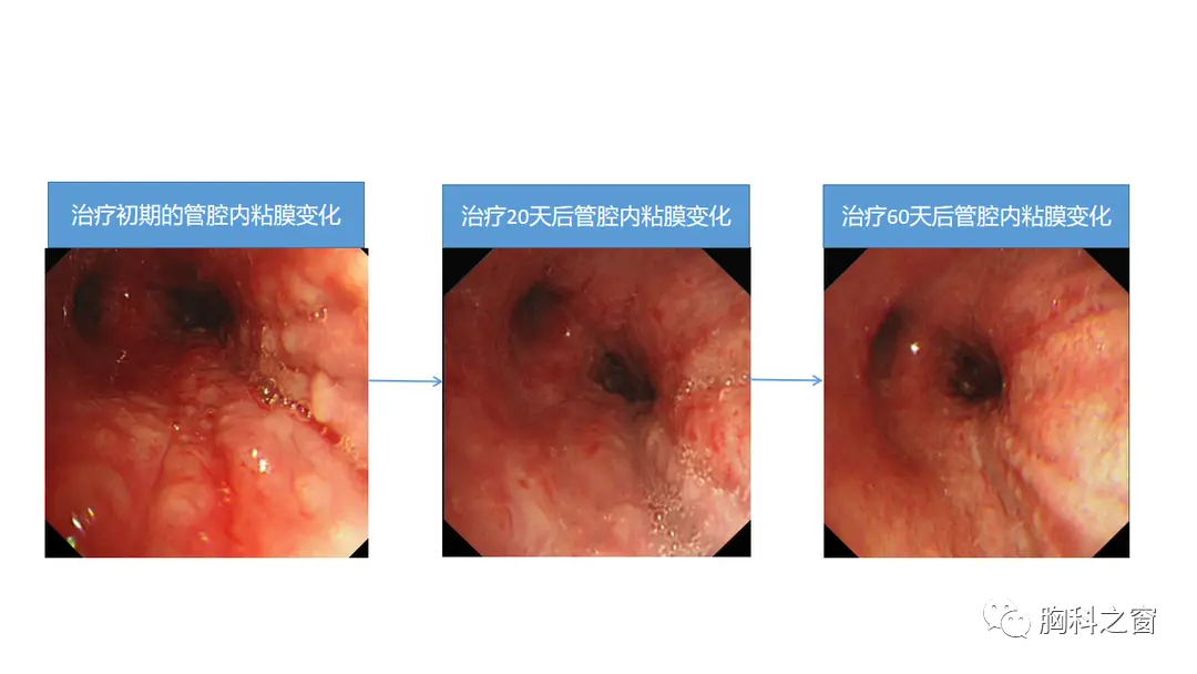 继发性肺结核能活多久_肺结核活性_肺能结核活性继发性肺炎吗